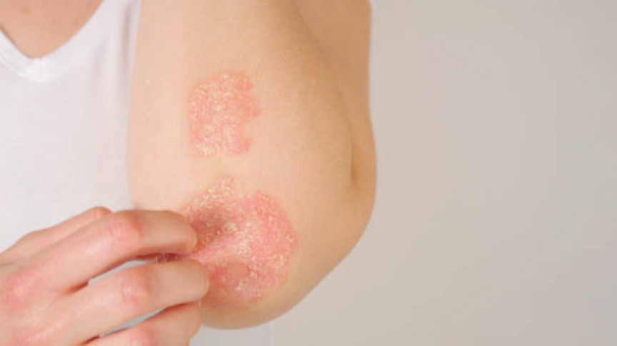 Psoriásis